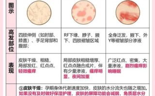 孕妇身上痒是怎么回事_孕妇皮肤瘙痒怎么缓解