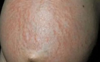 孕妇肚子上起了好多小红点_对胎儿有影响吗