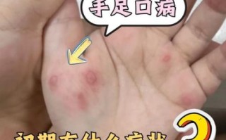 手足口病孕妇会传染给胎儿吗_孕期感染怎么办