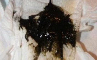 孕妇大便黑色怎么回事_对胎儿有影响吗