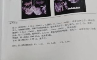 孕妇脉络丛囊肿概率_对胎儿有影响吗