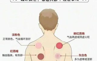 孕妇能拔罐吗_孕妇拔罐对胎儿有影响吗