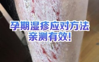 孕妇湿疹怎么快速止痒_孕妇湿疹止痒安全方法