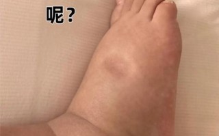孕妇腿肿是男孩吗_孕期水肿看男女准吗