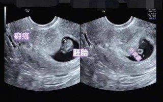 孕妇做b超需要空腹吗_孕早期b超注意事项