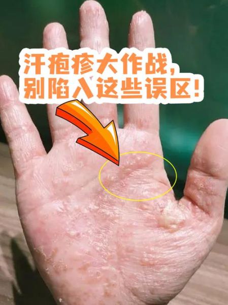 孕妇汗疱疹怎么治疗_孕期汗疱疹会自愈吗-第1张图片-星辰妙记 孕妇汗疱疹怎么治疗_孕期汗疱疹会自愈吗-第1张图片-星辰妙记