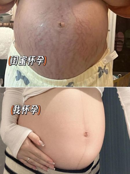 孕妇肚皮发硬正常吗_孕妇肚皮痒怎么办-第2张图片-星辰妙记