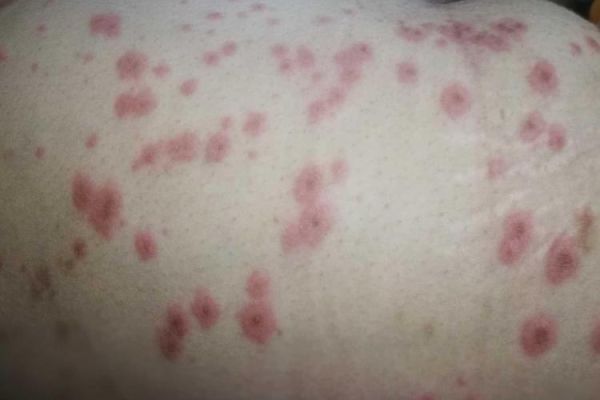 孕妇胆汁淤积症状图片_如何自我识别-第2张图片-星辰妙记