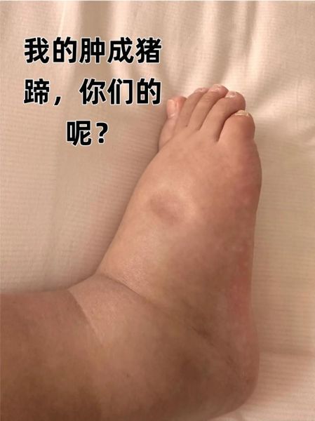 孕妇腿肿是男孩吗_孕期水肿看男女准吗-第1张图片-星辰妙记