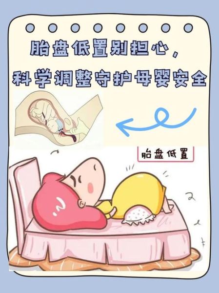 孕妇胎盘低置怎么办_胎盘低置能顺产吗-第1张图片-星辰妙记