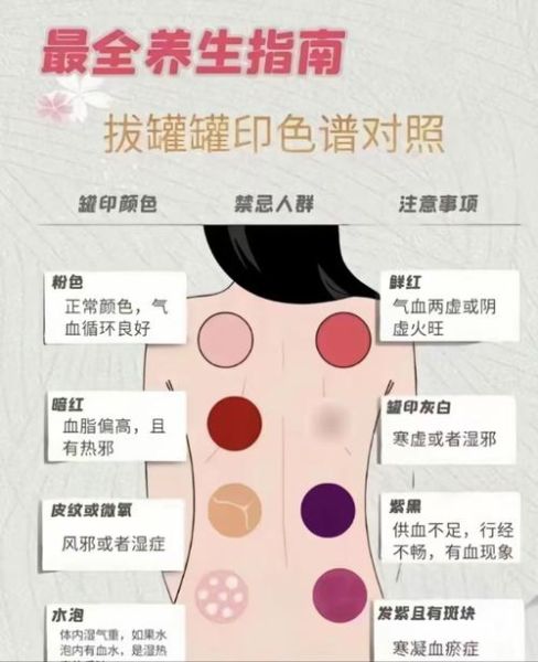 孕妇可以拔罐吗_孕期拔罐安全指南-第1张图片-星辰妙记