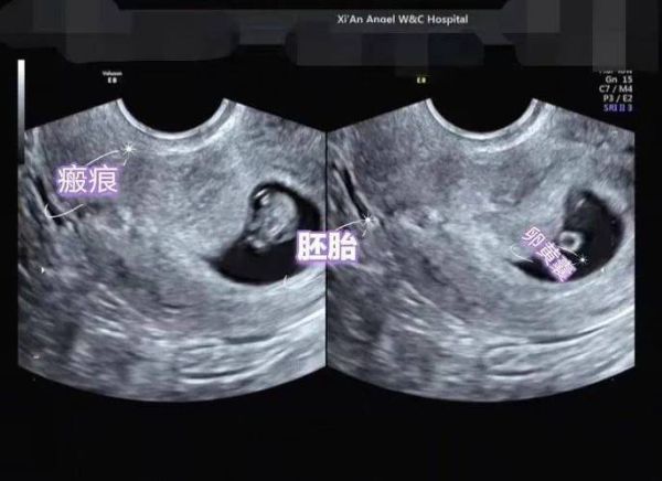 孕妇做b超需要空腹吗_孕早期b超注意事项-第1张图片-星辰妙记 孕妇做b超需要空腹吗_孕早期b超注意事项-第1张图片-星辰妙记