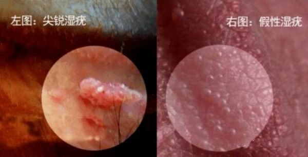 孕妇下面长了个硬疙瘩怎么办_孕妇外阴硬疙瘩原因-第3张图片-星辰妙记