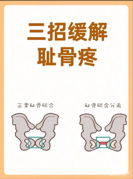 孕妇耻骨痛怎么缓解_耻骨联合痛缓解方法-第1张图片-星辰妙记
