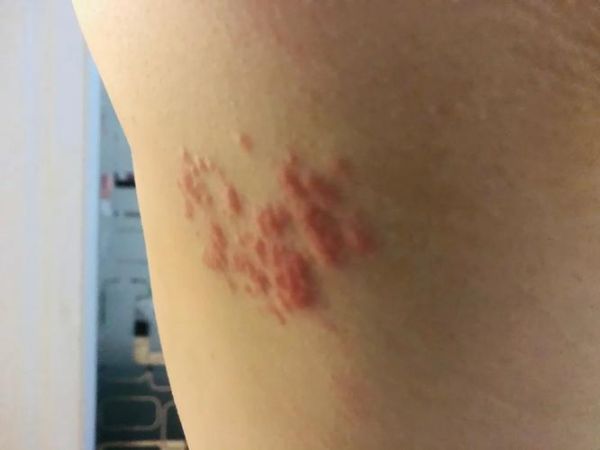 孕妇带状疱疹能自愈吗_对胎儿影响大吗-第3张图片-星辰妙记