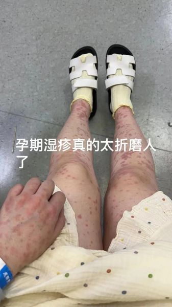 孕妇湿疹图片_孕妇湿疹怎么办-第3张图片-星辰妙记