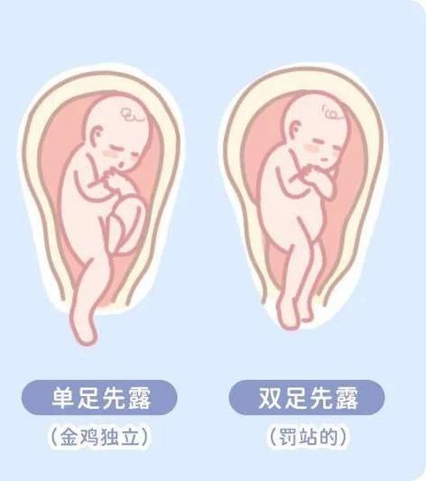孕妇LOA胎位是什么意思_LOA胎位顺产几率大吗-第2张图片-星辰妙记 孕妇LOA胎位是什么意思_LOA胎位顺产几率大吗-第2张图片-星辰妙记