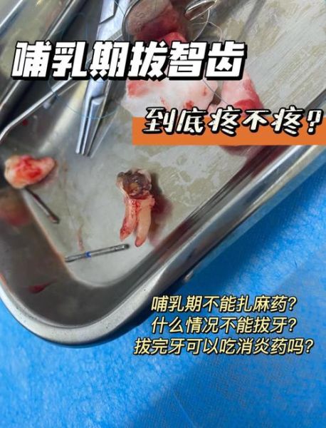 孕妇可以拔牙齿吗_孕期拔牙安全吗-第1张图片-星辰妙记