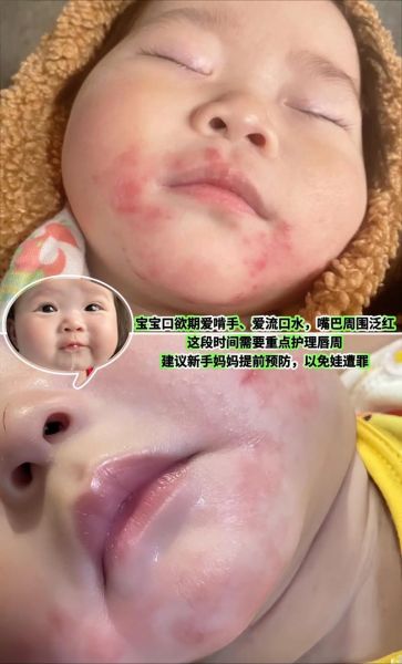 孕妇嘴角长疱疹怎么办_会影响胎儿吗-第2张图片-星辰妙记 孕妇嘴角长疱疹怎么办_会影响胎儿吗-第2张图片-星辰妙记