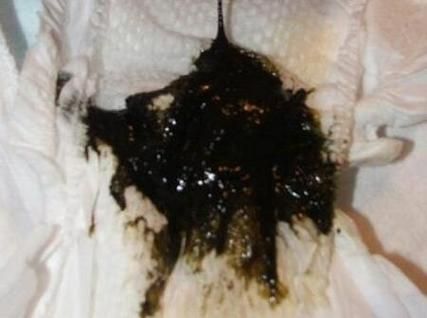 孕妇大便黑色怎么回事_对胎儿有影响吗-第1张图片-星辰妙记