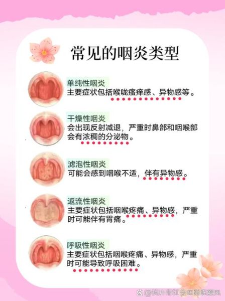 孕妇嗓子疼怎么办_孕妇嗓子疼能吃什么药-第1张图片-星辰妙记