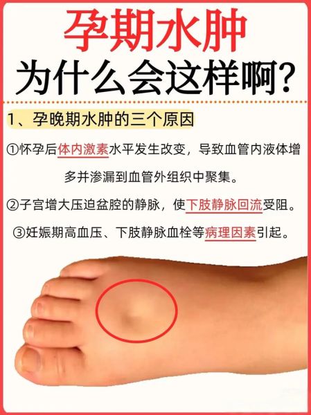 孕妇肿是怎么回事_如何快速消肿-第1张图片-星辰妙记