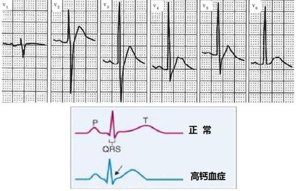 孕妇st段改变严重吗_st段压低对胎儿有影响吗-第3张图片-星辰妙记 孕妇st段改变严重吗_st段压低对胎儿有影响吗-第3张图片-星辰妙记