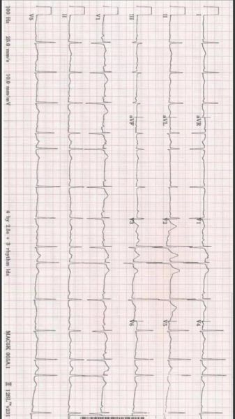孕妇st段改变严重吗_st段压低对胎儿有影响吗-第2张图片-星辰妙记 孕妇st段改变严重吗_st段压低对胎儿有影响吗-第2张图片-星辰妙记