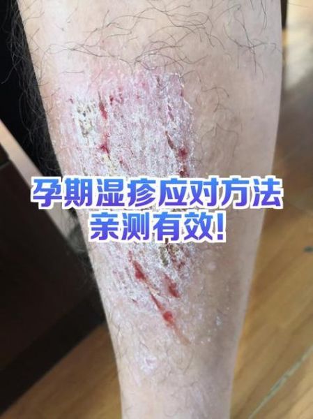 孕妇湿疹怎么快速止痒_孕妇湿疹止痒安全方法-第1张图片-星辰妙记