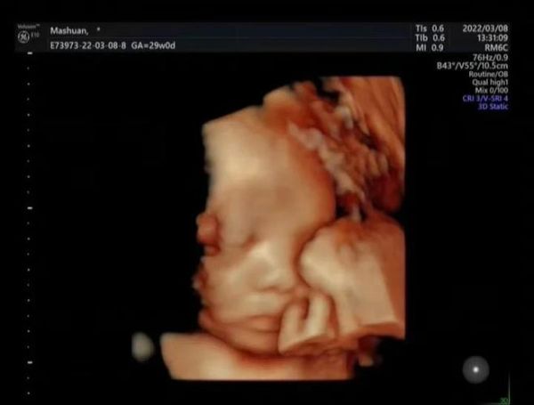 孕妇5个月四维彩超怎么看_四维彩超检查什么-第3张图片-星辰妙记