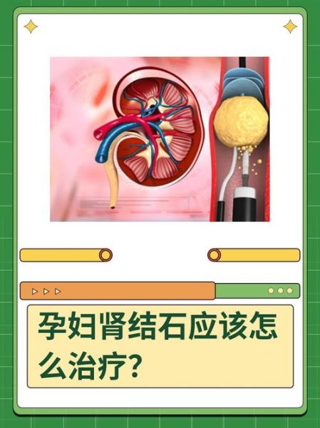 孕妇结石怎么办_孕妇结石对胎儿有影响吗-第1张图片-星辰妙记